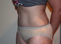 Tummy Tuck