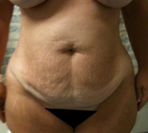 Tummy Tuck Case 466 Before Photo Tummy Tuck
