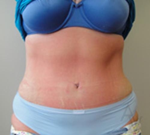 Tummy Tuck Case 466 After Photo Tummy Tuck