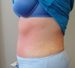 Tummy Tuck