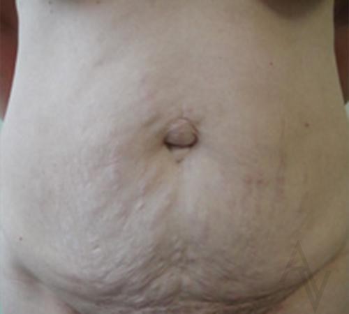 Tummy Tuck