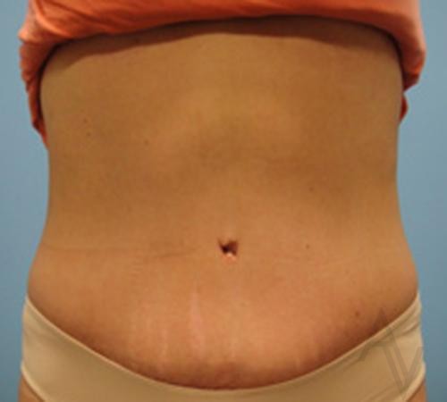 Tummy Tuck