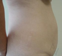 Tummy Tuck