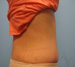 Tummy Tuck