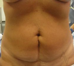 Tummy Tuck