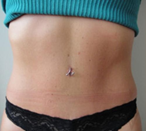 Tummy Tuck Case 468 After Photo Tummy Tuck