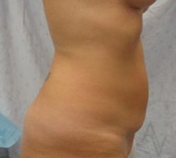 Tummy Tuck