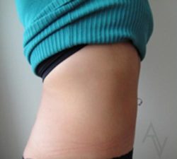 Tummy Tuck