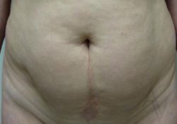 Tummy Tuck