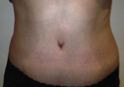 Tummy Tuck