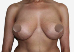 Breast Lift