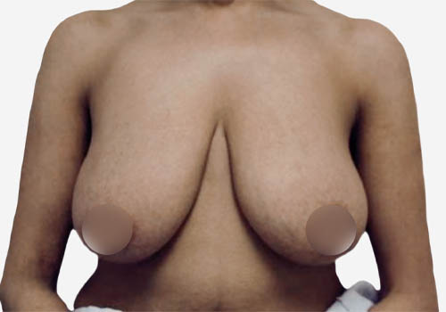 Breast Lift