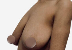 Breast Lift