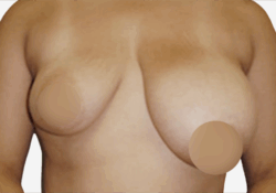 Breast Asymmetry Correction
