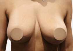 Breast Asymmetry Correction
