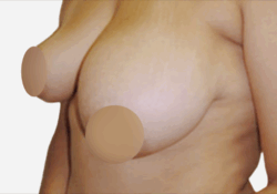 Breast Asymmetry Correction