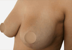 Breast Asymmetry Correction