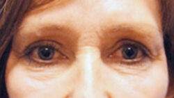 Eyelid Surgery
