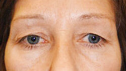 Eyelid Surgery