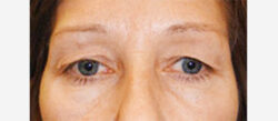 Eyelid Surgery