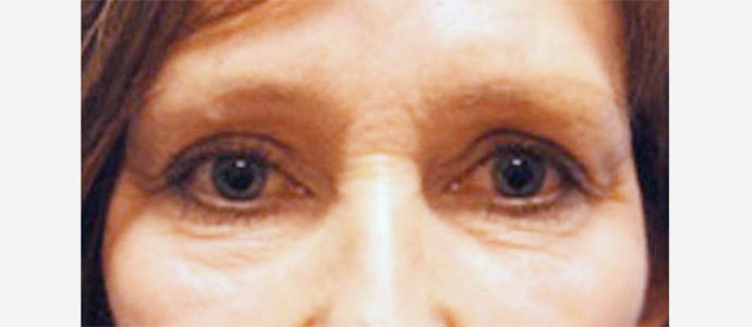 Eyelid Surgery