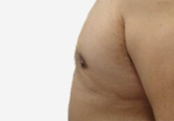 Male Breast Reduction