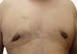 Male Breast Reduction