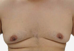 Male Breast Reduction