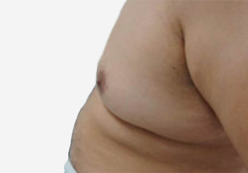 Male Breast Reduction