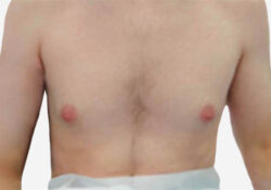 Male Breast Reduction