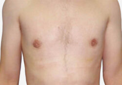 Male Breast Reduction