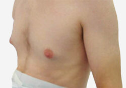 Male Breast Reduction