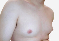 Male Breast Reduction