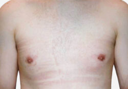 Male Breast Reduction