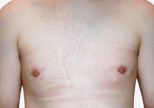 Male Breast Reduction