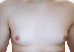 Male Breast Reduction