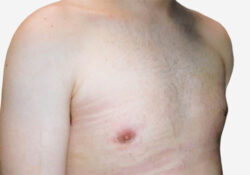 Male Breast Reduction