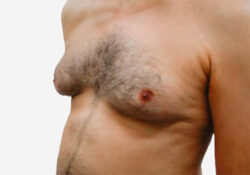 Male Breast Reduction