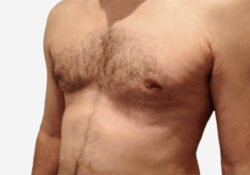 Male Breast Reduction