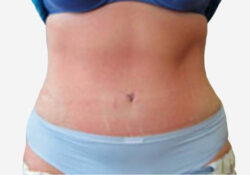 Tummy Tuck