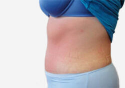 Tummy Tuck