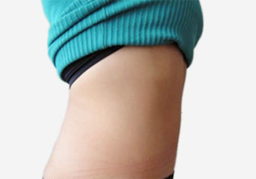 Tummy Tuck