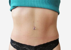 Tummy Tuck