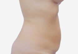 Tummy Tuck
