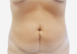 Tummy Tuck