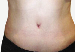Tummy Tuck