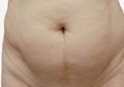 Tummy Tuck