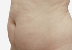 Tummy Tuck