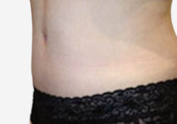 Tummy Tuck