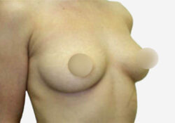 Breast Augmentation
